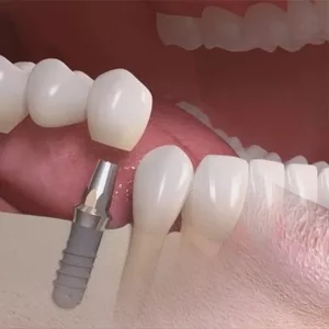 Лечение ,  протезирование и имплантация зубов в Полтаве на выгодных усл